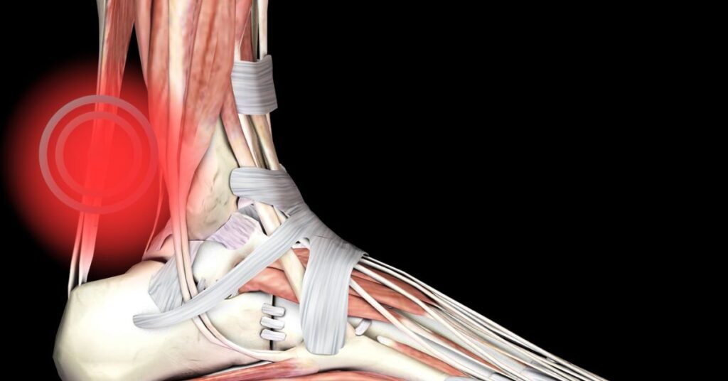aplicando tratamiento para la tendinitis de Aquiles en la zona del talón